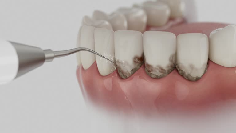 Trusted Wisdom Tooth Removal service in Menlo Park, CA - Dentist Open Now